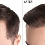 Best Hair Transplant in Pakistan