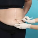 How to Reduce Body Weight by Bariatric Surgery