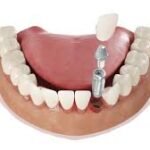 Natural-Looking Results With Expert Dental Implants