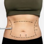 Liposuction in Abu Dhabi