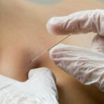 Acupuncture for Food Allergies: Can It Help?