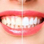 Teeth Whitening in the UK