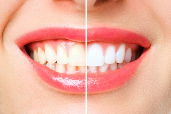 Teeth Whitening in the UK