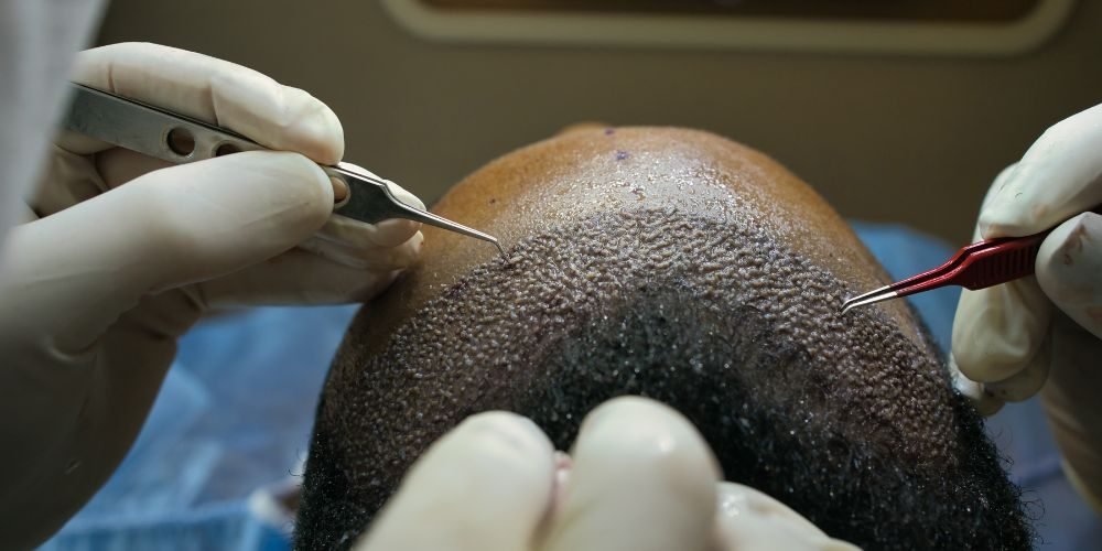 best hair transplant clinic in Lahore