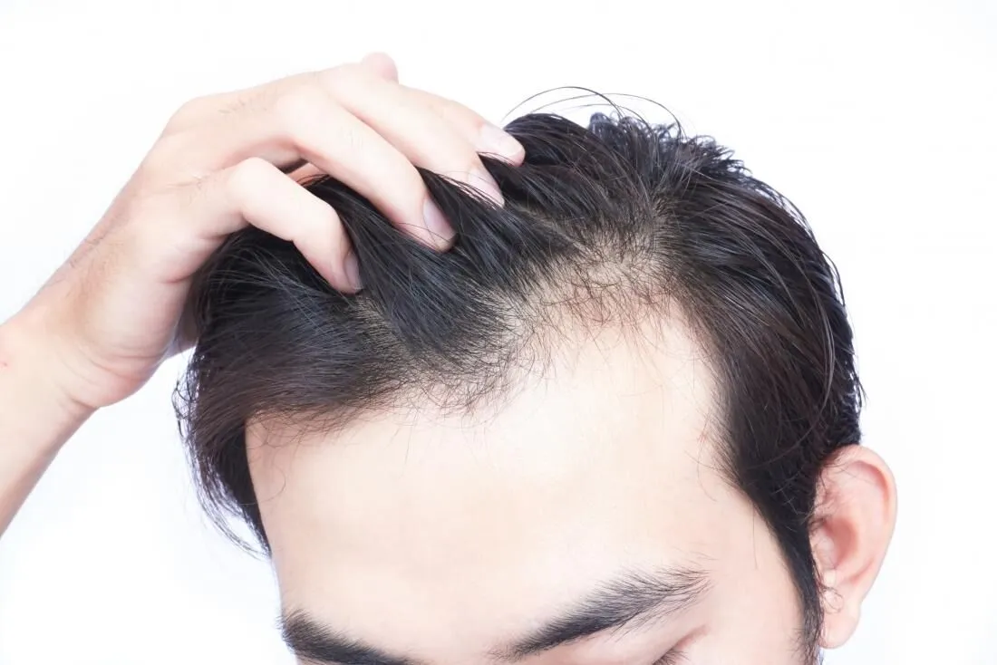 hair loss treatment for men